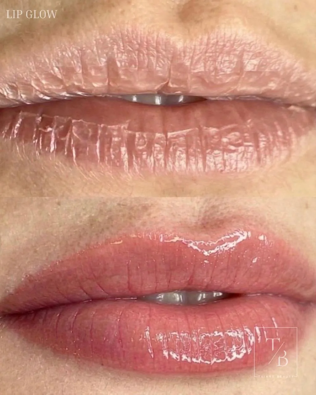 Resultado de revitalização labial